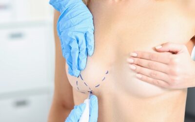 Reducción de pecho: mucho más que una cuestión estética