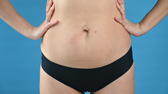 mujeres-muestran-vientre-despues-nacimiento-estrias-diastasis-sobre-fondo-azul-foto-alta-calidad (1)